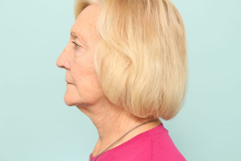 Neck Lift Newark DE | Premier Cosmetic Surgery DE