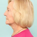 Neck Lift Newark DE | Premier Cosmetic Surgery DE