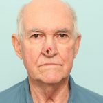 MOHS Reconstruction Delaware | Premier Cosmetic Surgery DE